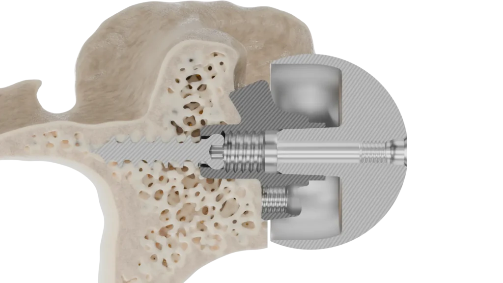 InSet® reverse shoulder baseplate seated in the glenoid bone