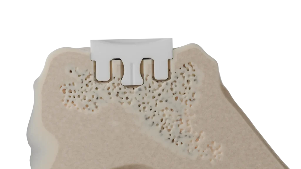 InSet® glenoid implant in a bone model