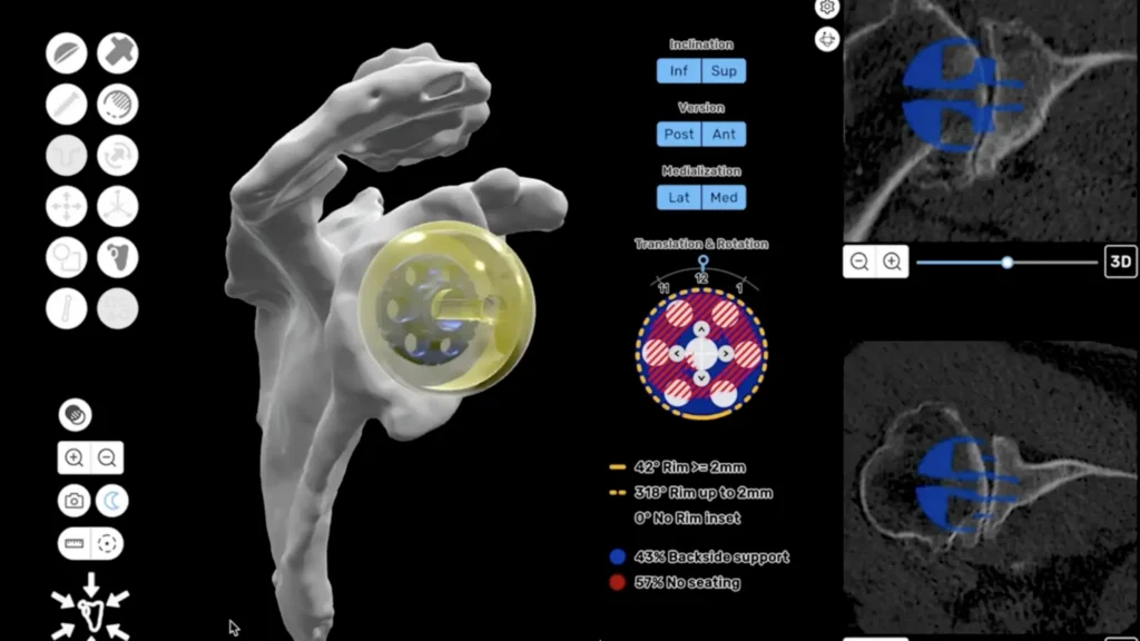 Reverse Shoulder Replacement Planning Software ProVoyance™