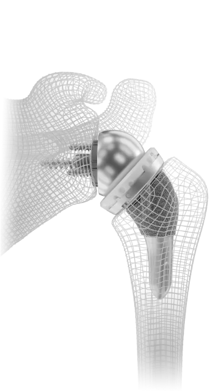 Reverse shoulder replacement implant in a bone model