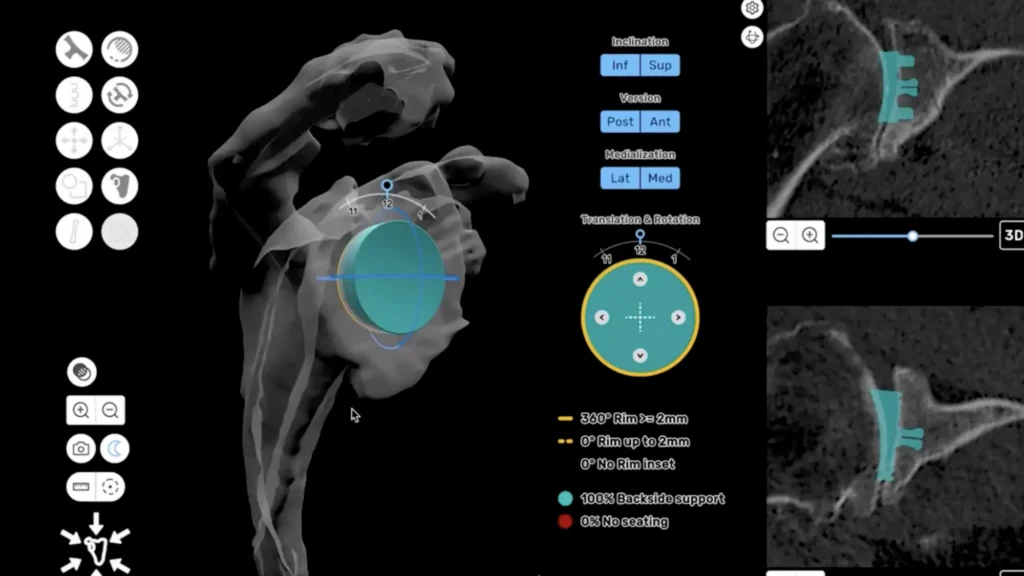 3D CT-based preoperative plan of a total shoulder replacement using ProVoyance software