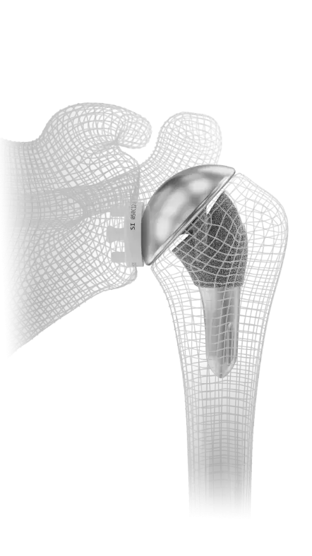 Total shoulder replacement implant in a bone model