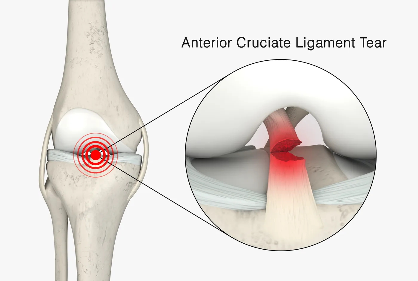 3D illustration of an anterior cruciate ligament (ACL) tear in the knee