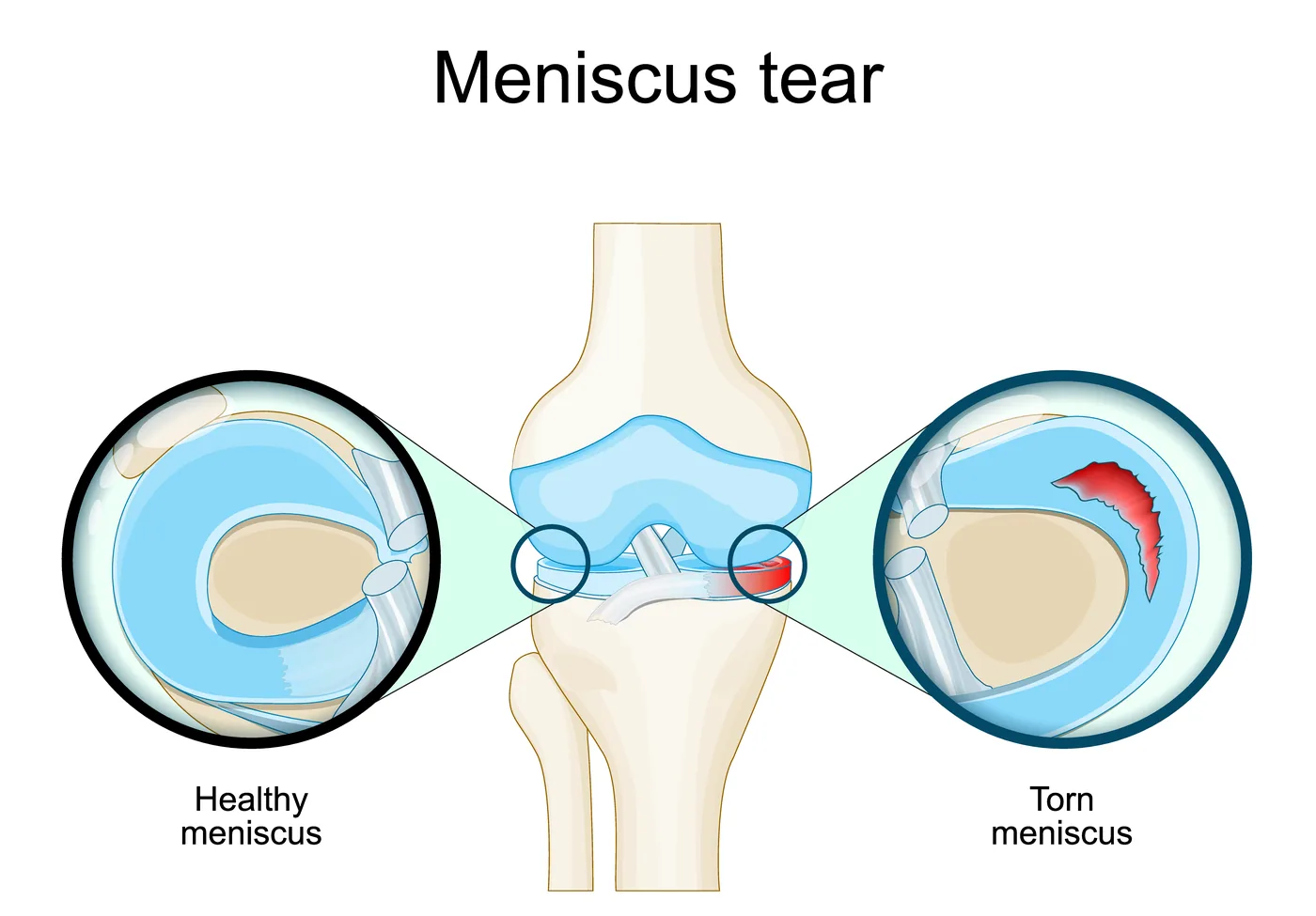 Illustration comparing a healthy meniscus with a torn meniscus in the knee