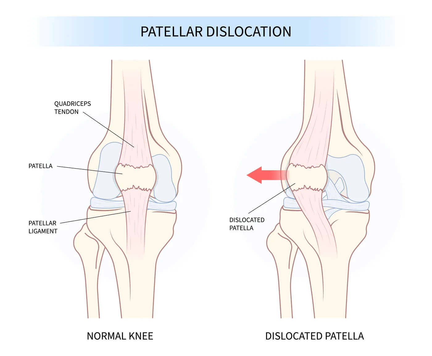 Illustration of patellar dislocation and kneecap instability