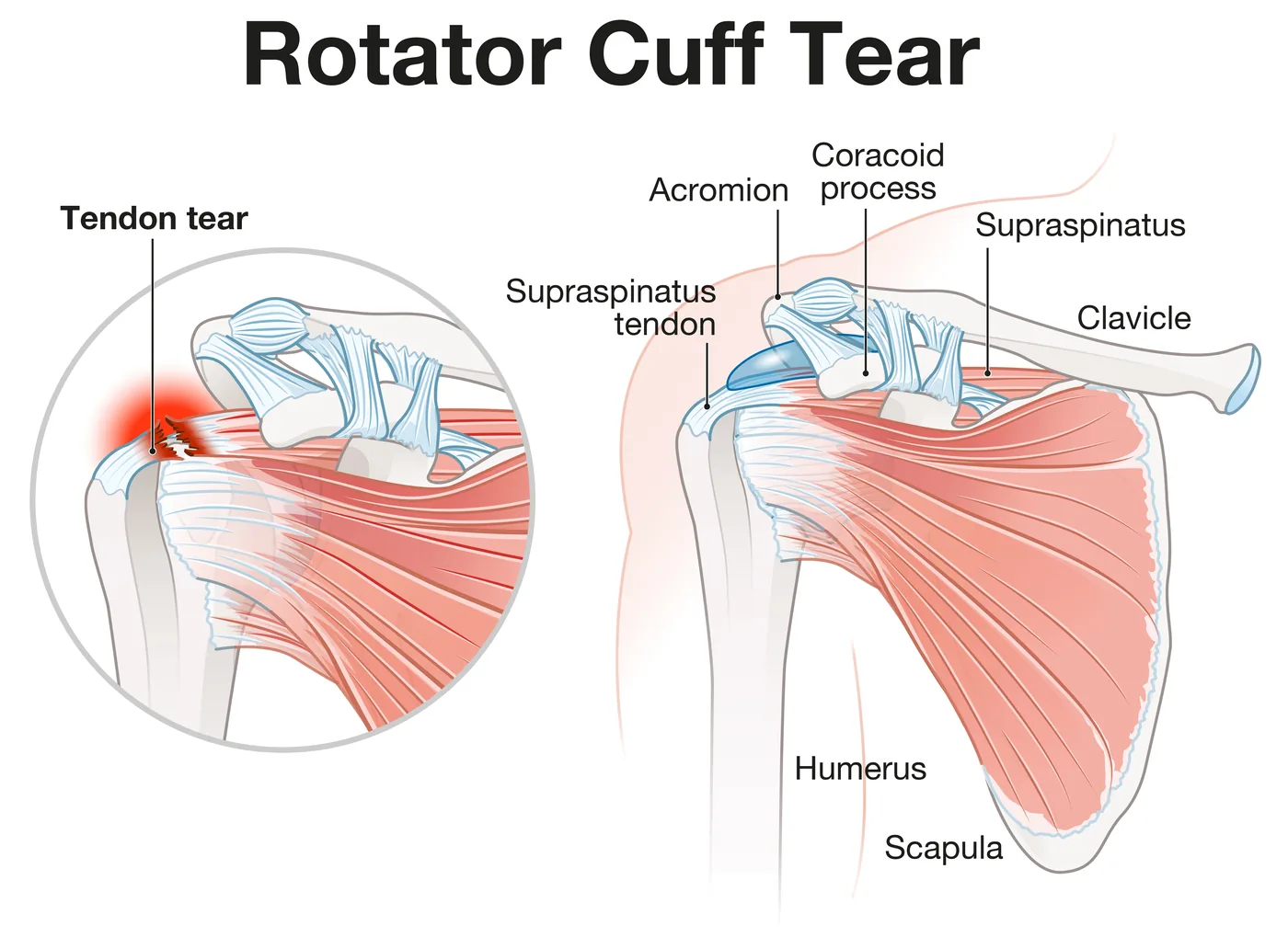 Medical illustration comparing a torn rotator cuff tendon with normal shoulder anatomy