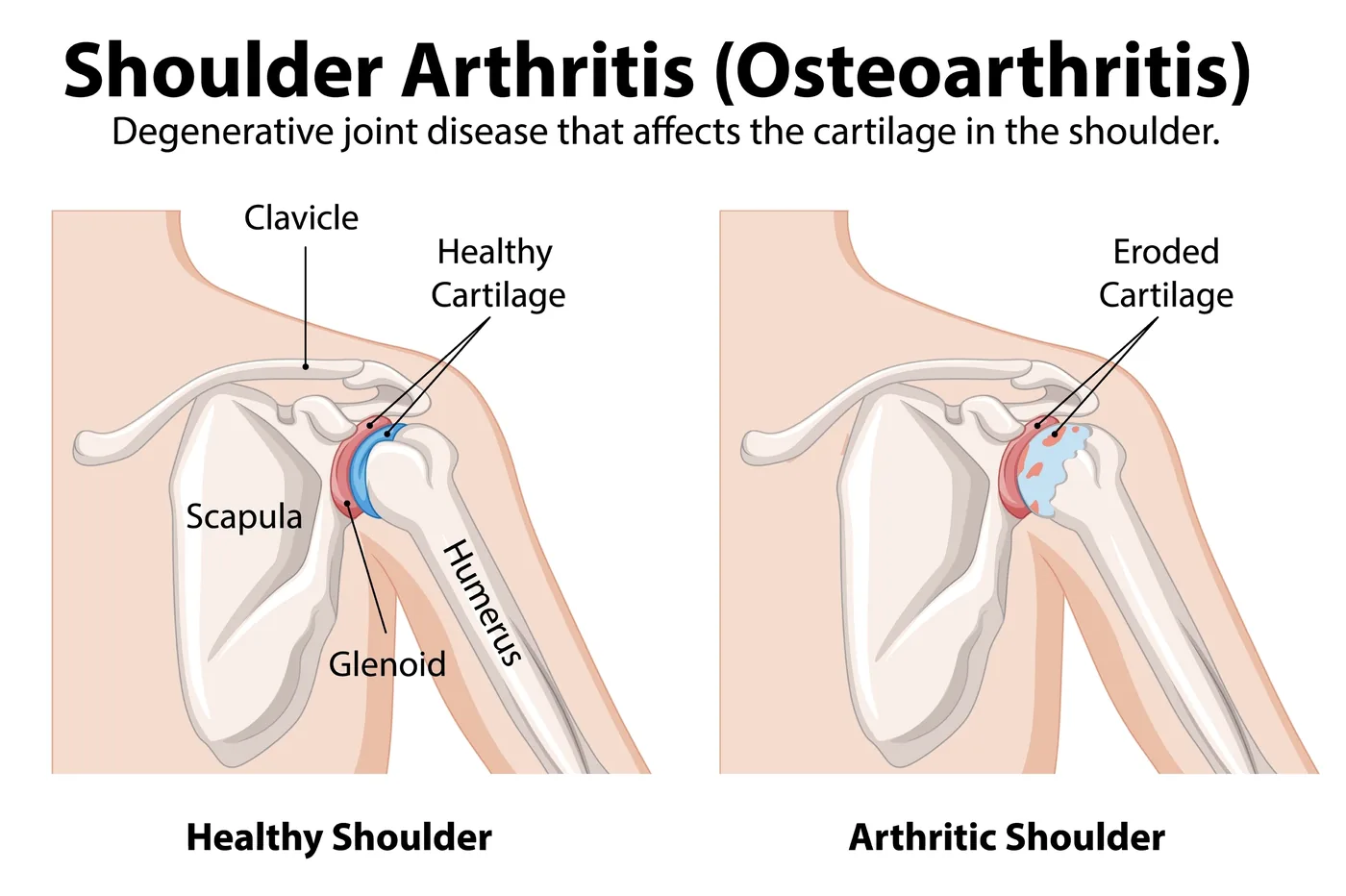 Illustration comparing a healthy shoulder joint with an arthritic shoulder joint with eroded cartilage