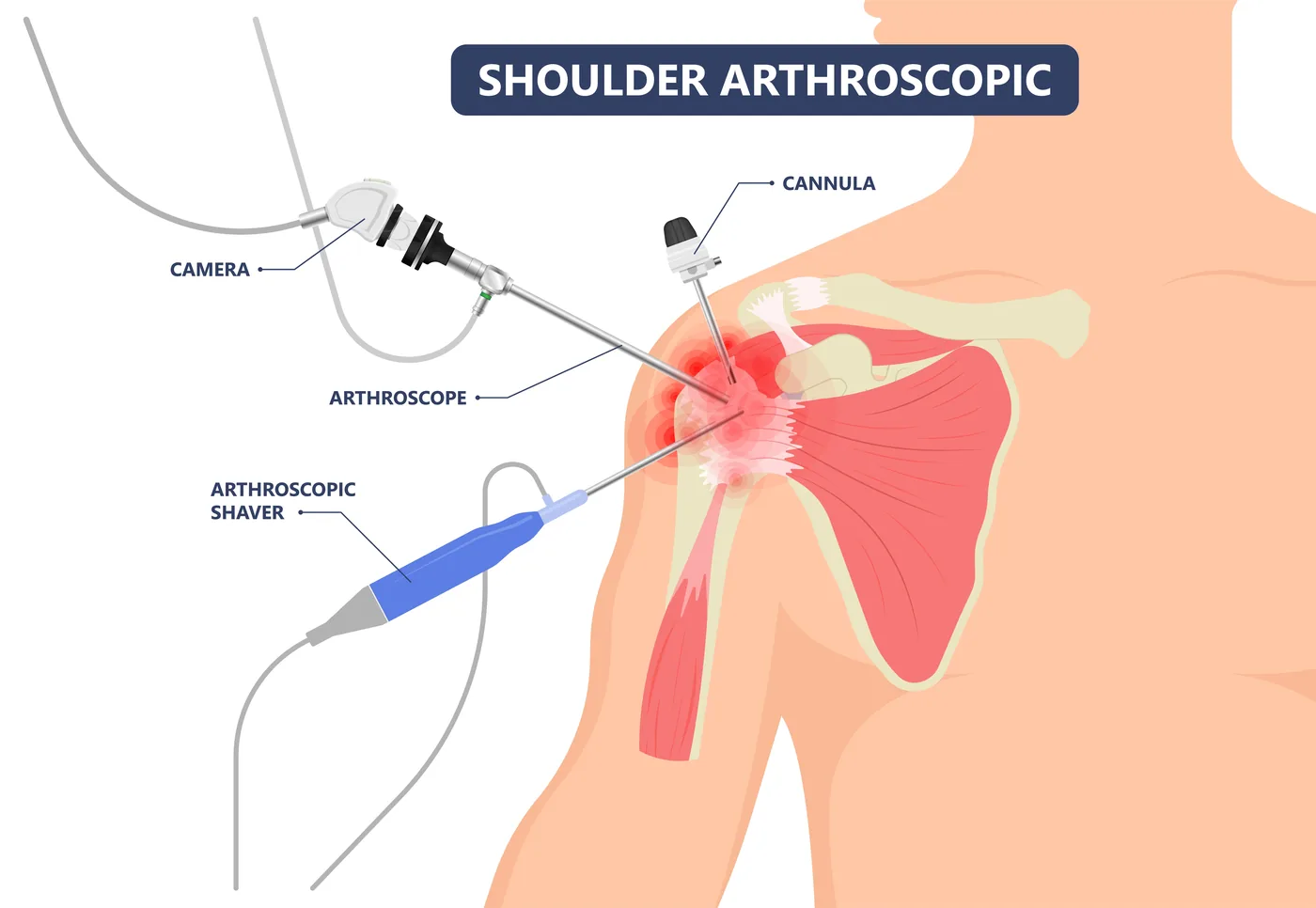 Illustration of shoulder arthroscopy showing a small camera and instruments used for rotator cuff repair
