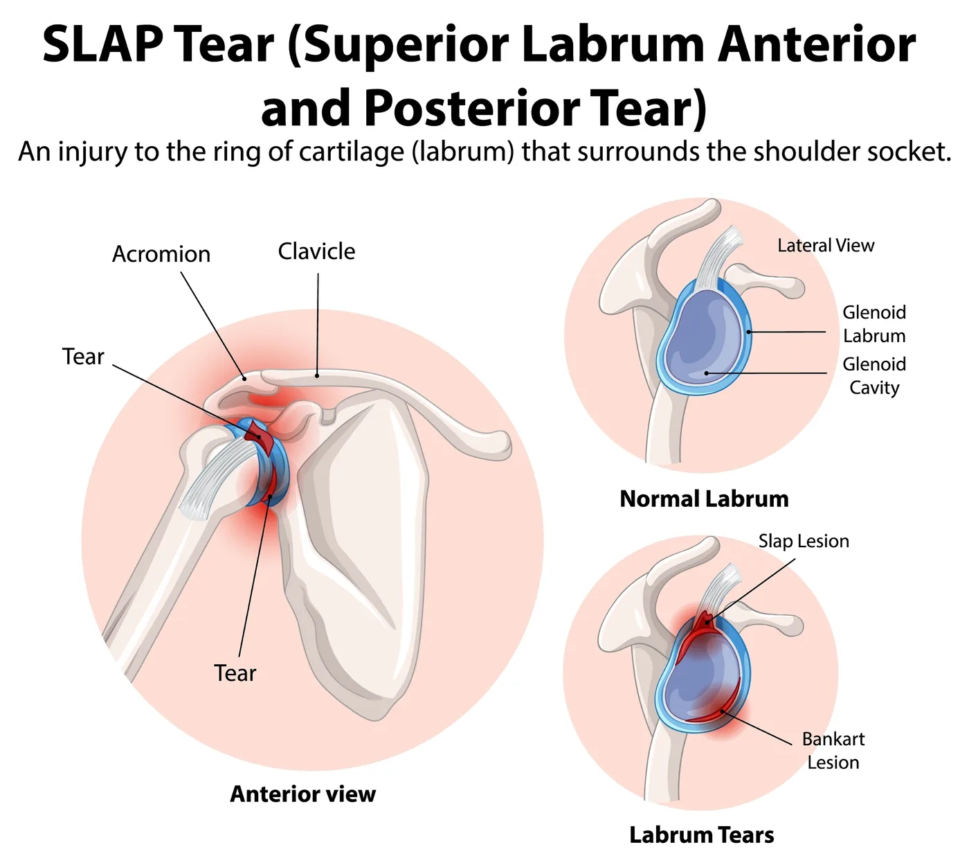 Diagram of a SLAP tear showing injury to the labrum, the ring of cartilage surrounding the shoulder socket